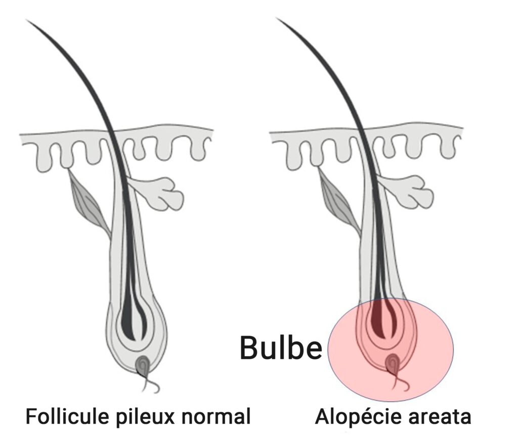 Schéma comparatif entre un follicule pileux normal et un follicule atteint d’alopécie areata, illustrant la perte de cheveux auto-immune.