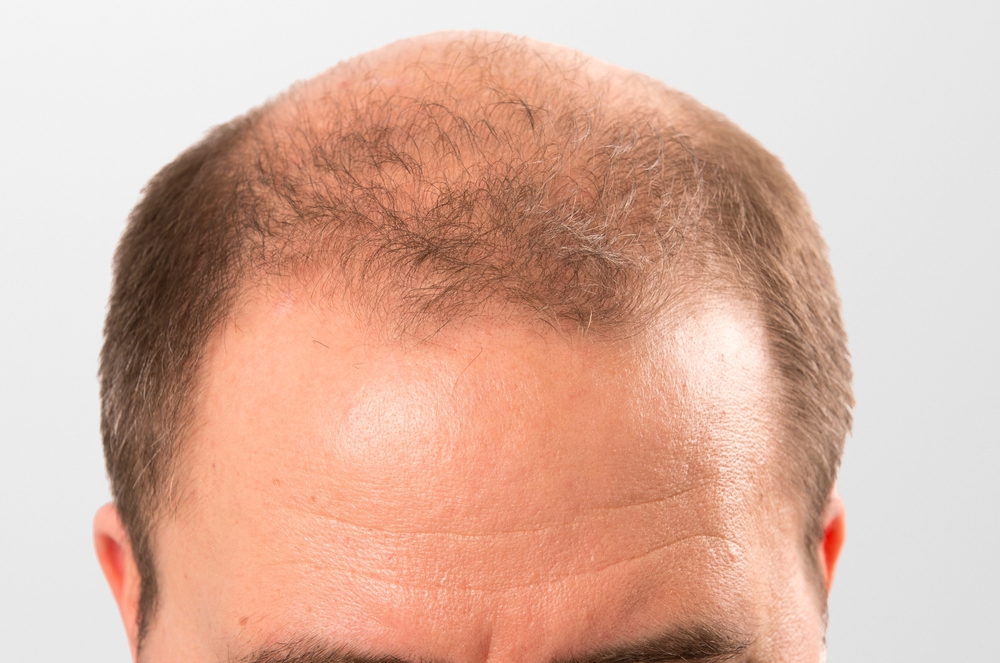 Homme présentant une alopécie androgénétique avec une calvitie marquée sur le dessus du crâne.